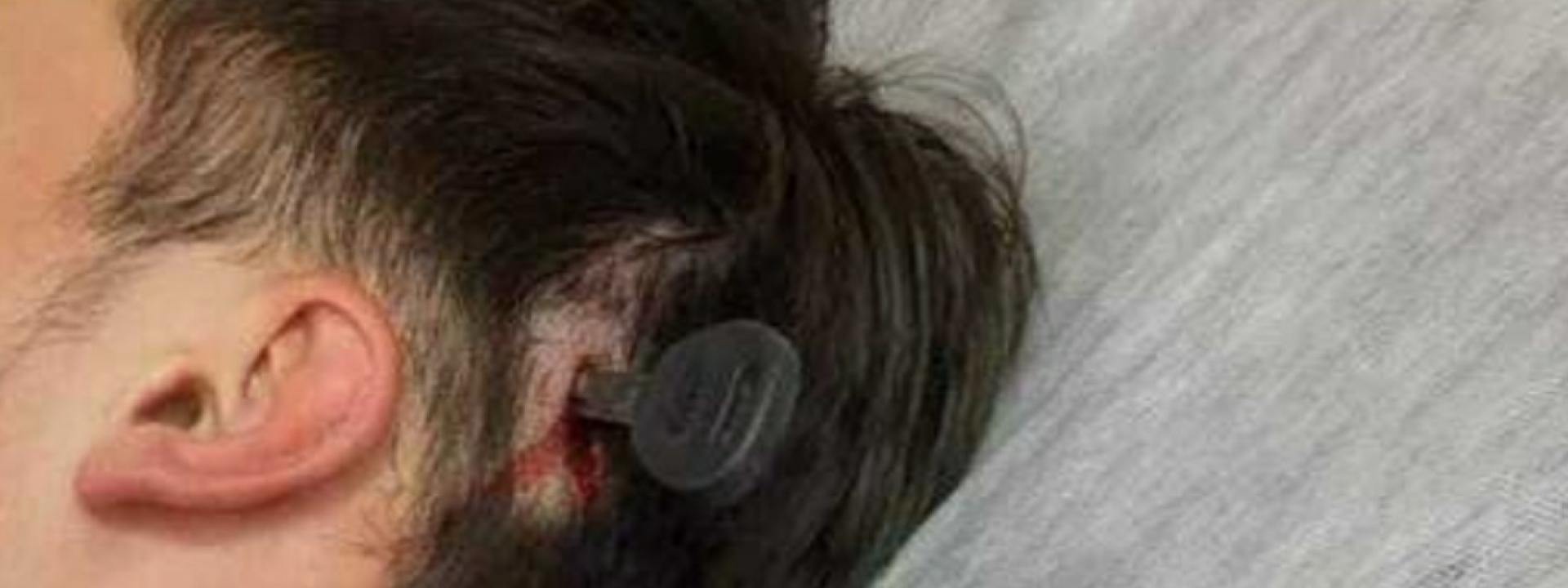 Choc in campo: scoppia la rissa e un 12enne si ritrova una chiave infilata in testa